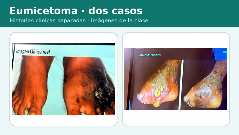 Miniatura de los dos casos clínicos de eumicetoma